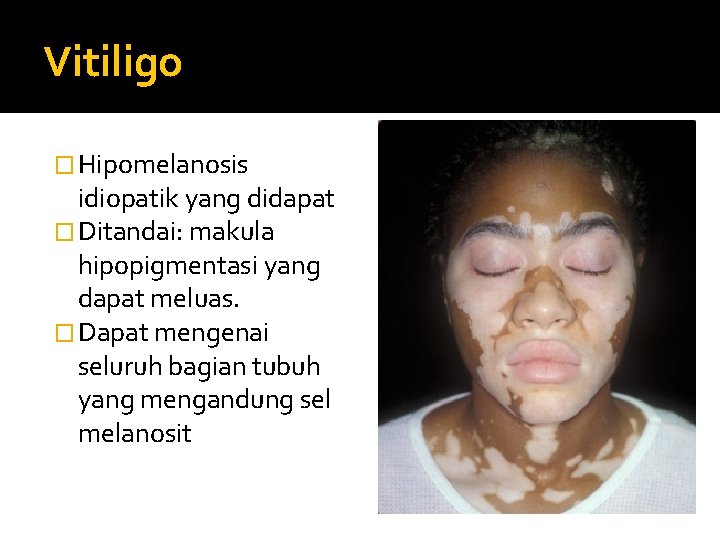 Vitiligo � Hipomelanosis idiopatik yang didapat � Ditandai: makula hipopigmentasi yang dapat meluas. �