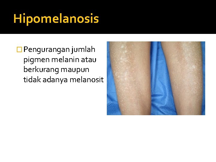 Hipomelanosis � Pengurangan jumlah pigmen melanin atau berkurang maupun tidak adanya melanosit 