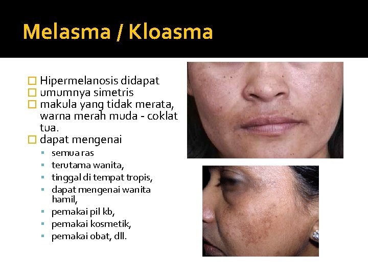 Melasma / Kloasma � Hipermelanosis didapat � umumnya simetris � makula yang tidak merata,