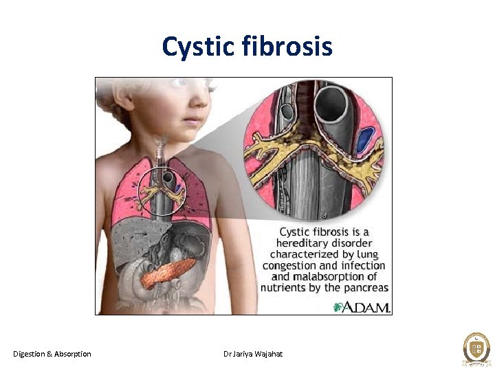 Cystic fibrosis Digestion & Absorption Dr Jariya Wajahat 
