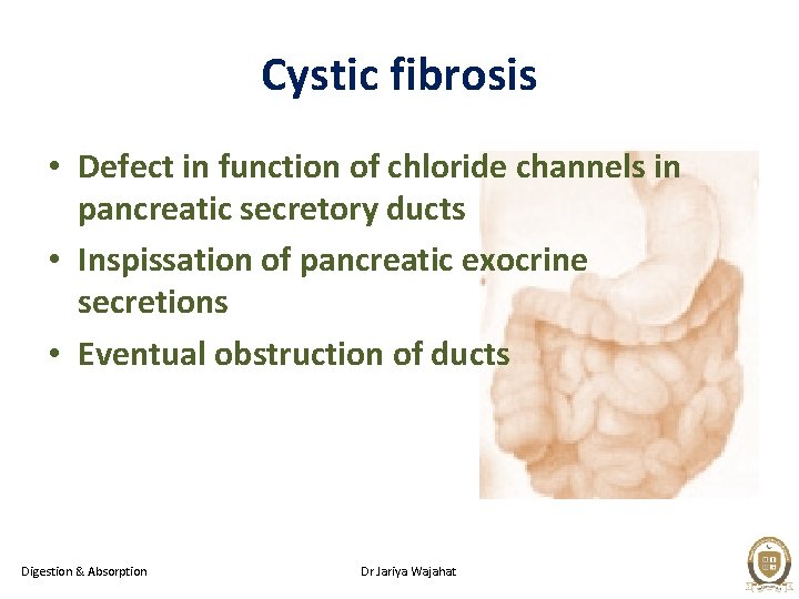 Cystic fibrosis • Defect in function of chloride channels in pancreatic secretory ducts •