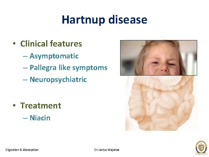 Hartnup disease • Clinical features – Asymptomatic – Pallegra like symptoms – Neuropsychiatric •