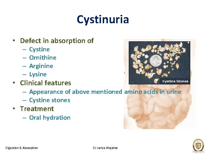Cystinuria • Defect in absorption of – – Cystine Ornithine Arginine Lysine • Clinical