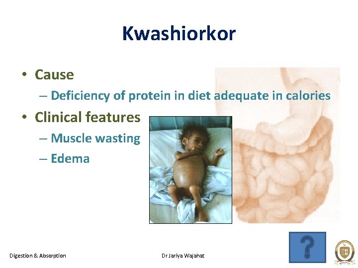 Kwashiorkor • Cause – Deficiency of protein in diet adequate in calories • Clinical