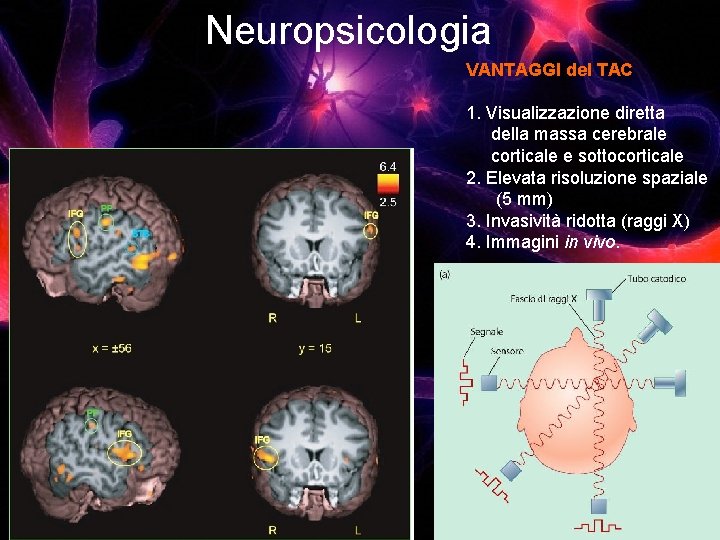 Neuropsicologia VANTAGGI del TAC 1. Visualizzazione diretta della massa cerebrale corticale e sottocorticale 2.