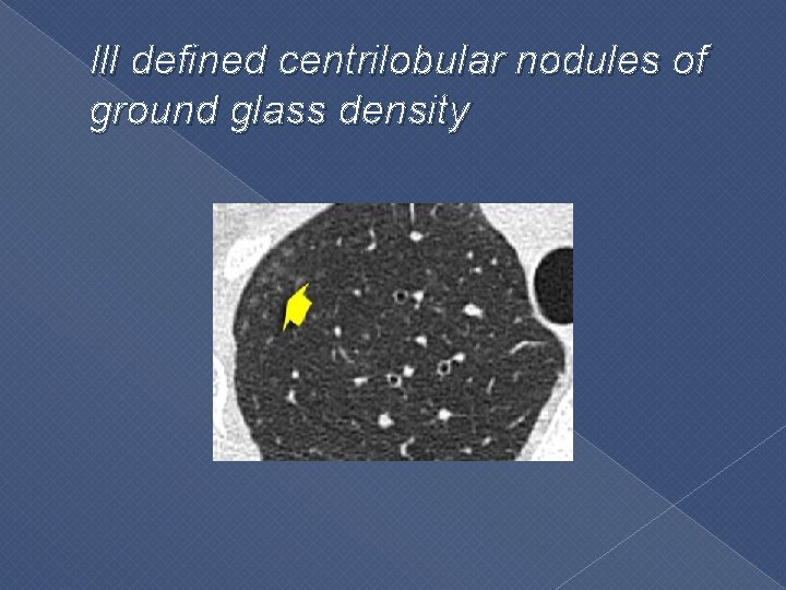 Ill defined centrilobular nodules of ground glass density 