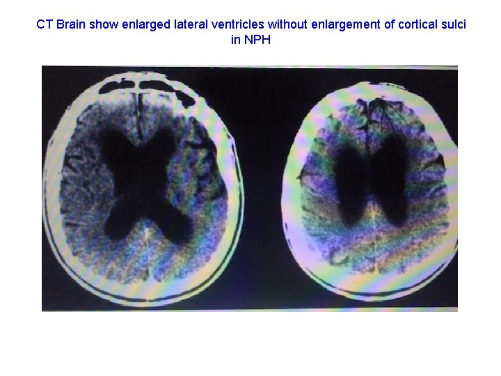 CT Brain show enlarged lateral ventricles without enlargement of cortical sulci in NPH 