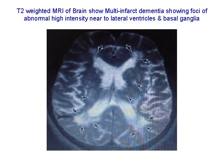 T 2 weighted MRI of Brain show Multi-infarct dementia showing foci of abnormal high