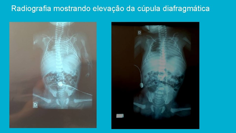 Radiografia mostrando elevação da cúpula diafragmática 