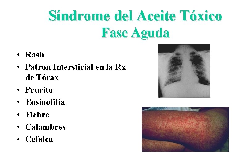 Síndrome del Aceite Tóxico Fase Aguda • Rash • Patrón Intersticial en la Rx