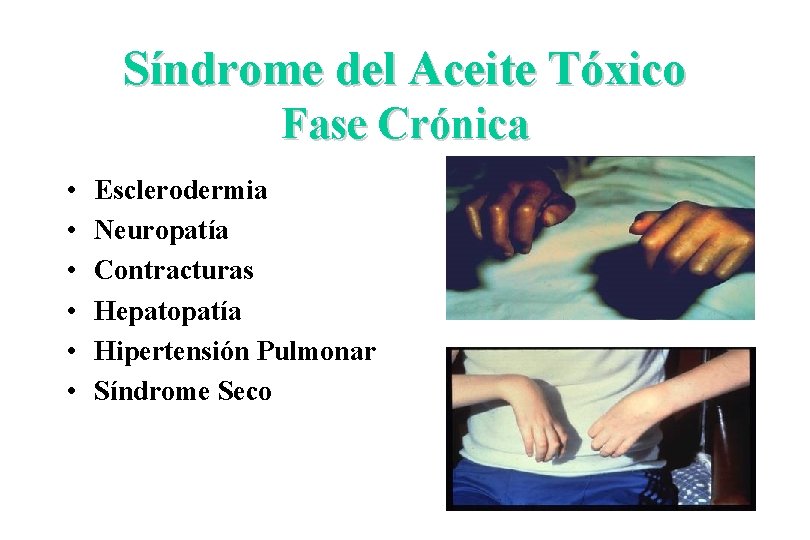 Síndrome del Aceite Tóxico Fase Crónica • • • Esclerodermia Neuropatía Contracturas Hepatopatía Hipertensión