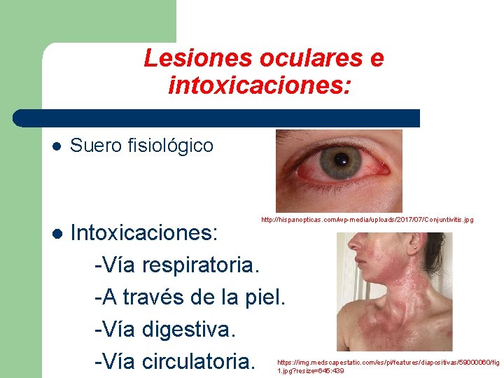  Lesiones oculares e intoxicaciones: l Suero fisiológico http: //hispanopticas. com/wp-media/uploads/2017/07/Conjuntivitis. jpg l Intoxicaciones: