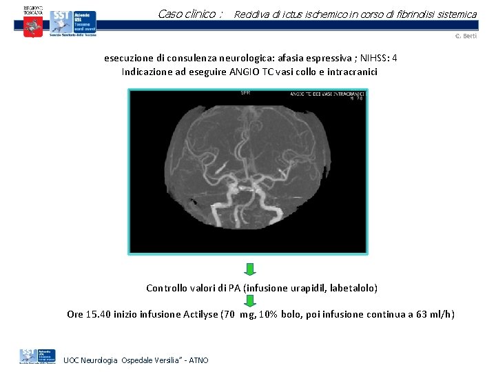 Caso clinico : Recidiva di ictus ischemico in corso di fibrinolisi sistemica C. Berti