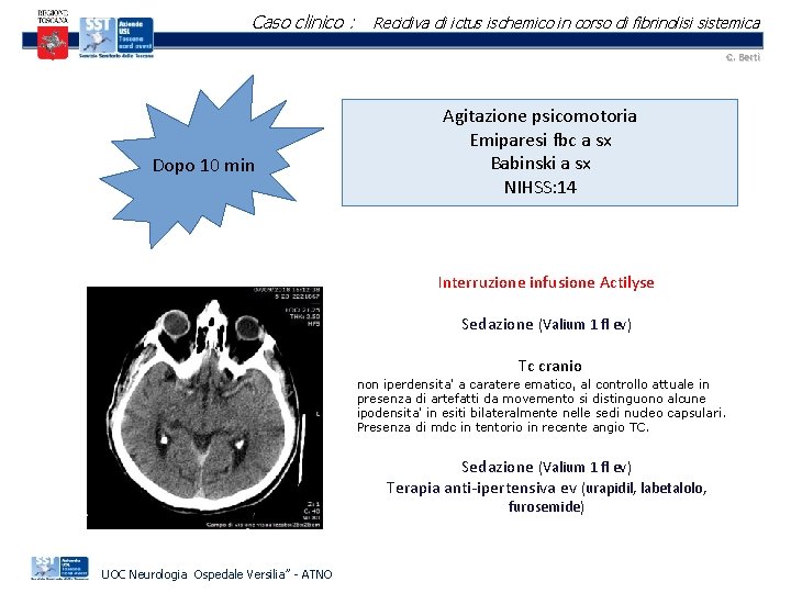 Caso clinico : Recidiva di ictus ischemico in corso di fibrinolisi sistemica C. Berti