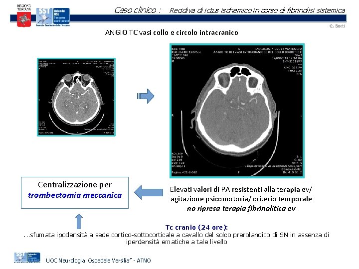 Caso clinico : Recidiva di ictus ischemico in corso di fibrinolisi sistemica ANGIO TC