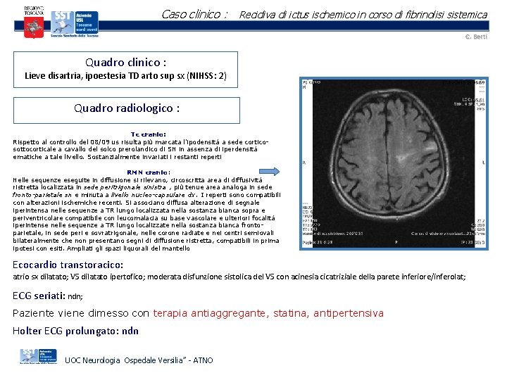 Caso clinico : Recidiva di ictus ischemico in corso di fibrinolisi sistemica C. Berti