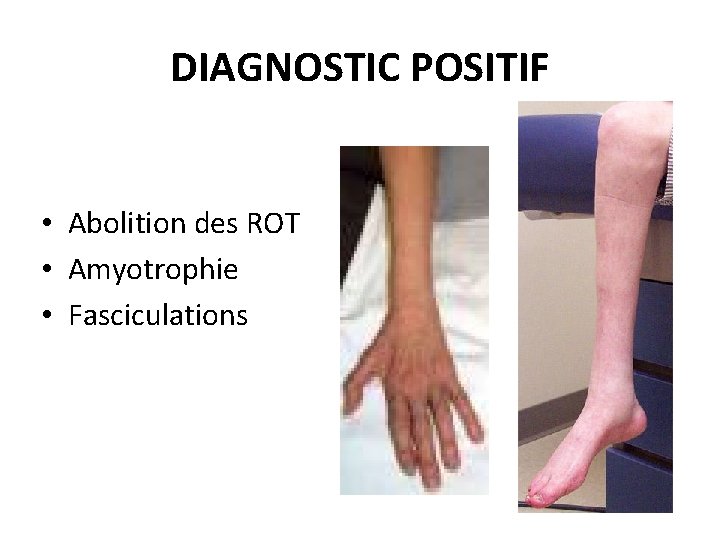 DIAGNOSTIC POSITIF • Abolition des ROT • Amyotrophie • Fasciculations 