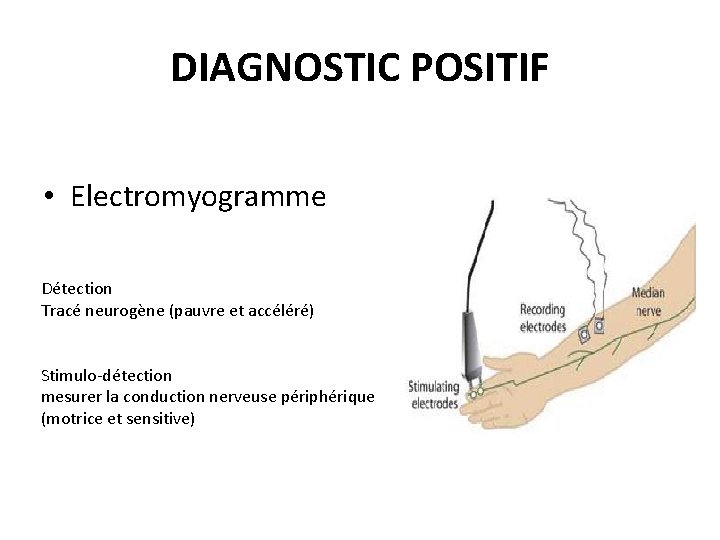 DIAGNOSTIC POSITIF • Electromyogramme Détection Tracé neurogène (pauvre et accéléré) Stimulo-détection mesurer la conduction