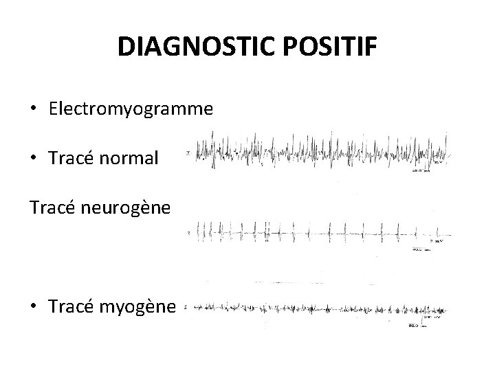 DIAGNOSTIC POSITIF • Electromyogramme • Tracé normal Tracé neurogène • Tracé myogène 