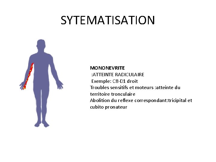 SYTEMATISATION MONONEVRITE : ATTEINTE RADICULAIRE Exemple: C 8 -D 1 droit Troubles sensitifs et