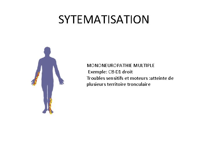 SYTEMATISATION MONONEUROPATHIE MULTIPLE Exemple: C 8 -D 1 droit Troubles sensitifs et moteurs :