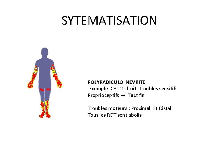 SYTEMATISATION POLYRADICULO NEVRITE Exemple: C 8 -D 1 droit Troubles sensitifs Proprioceptifs ++ Tact