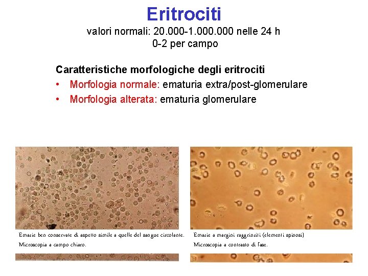 Eritrociti valori normali: 20. 000 -1. 000 nelle 24 h 0 -2 per campo