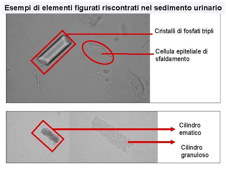 Esempi di elementi figurati riscontrati nel sedimento urinario Cristalli di fosfati tripli Cellula epiteliale