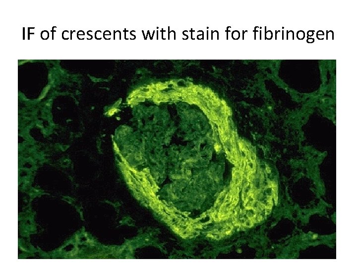 IF of crescents with stain for fibrinogen 