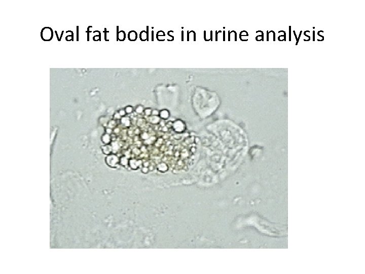 Oval fat bodies in urine analysis 