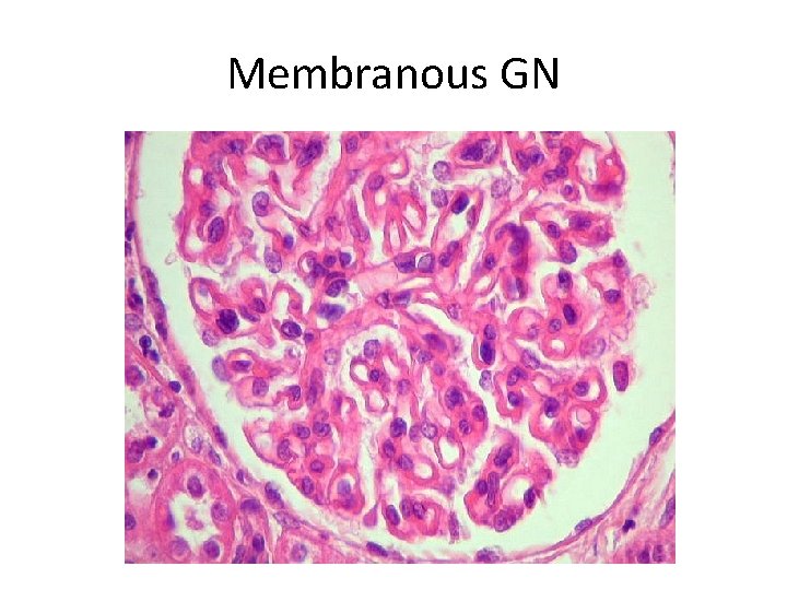 Membranous GN 
