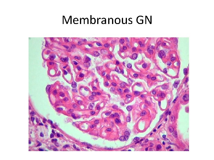 Membranous GN 