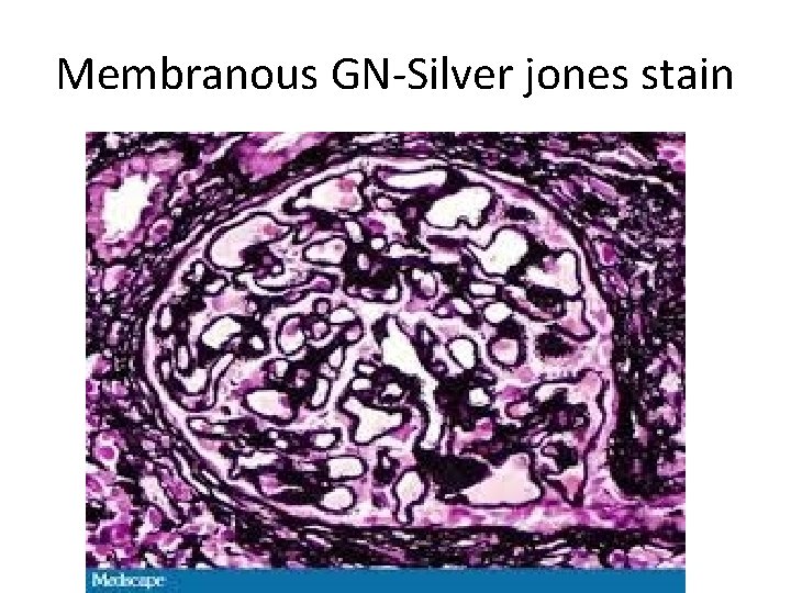 Membranous GN-Silver jones stain 
