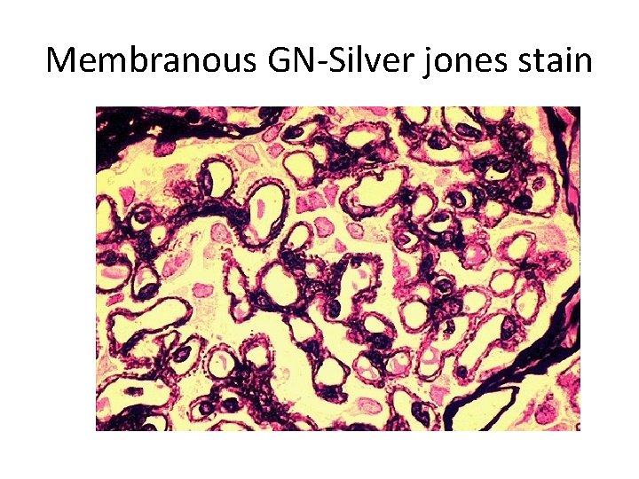 Membranous GN-Silver jones stain 