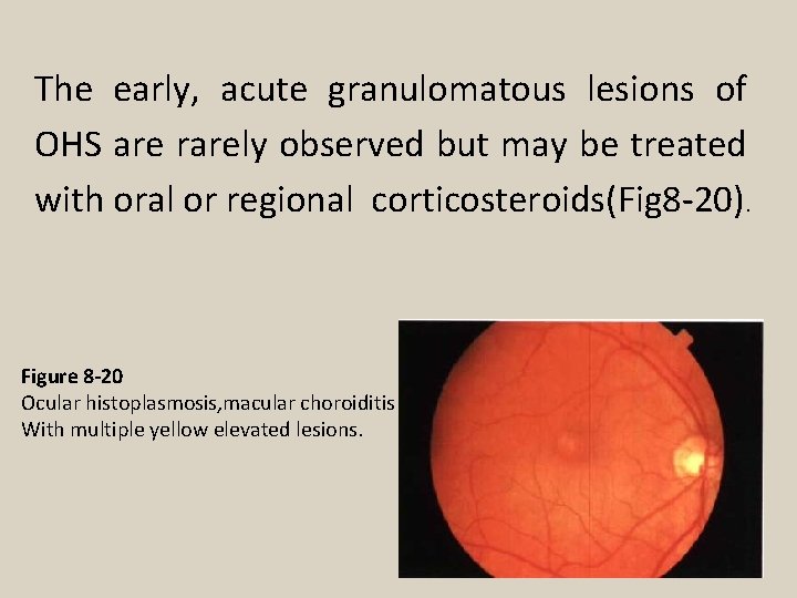 The early, acute granulomatous lesions of OHS are rarely observed but may be treated