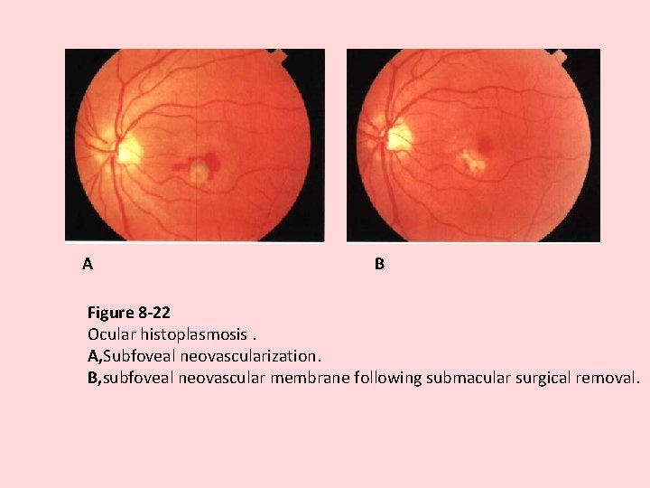 A B Figure 8 -22 Ocular histoplasmosis. A, Subfoveal neovascularization. B, subfoveal neovascular membrane