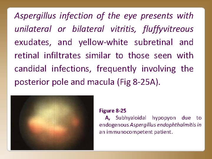 Aspergillus infection of the eye presents with unilateral or bilateral vitritis, fluffyvitreous exudates, and