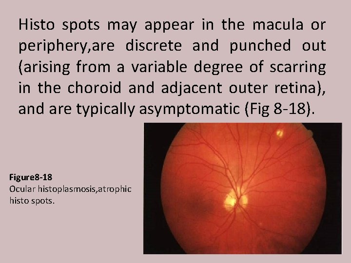 Histo spots may appear in the macula or periphery, are discrete and punched out