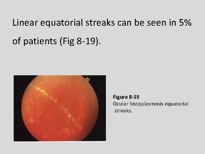 Linear equatorial streaks can be seen in 5% of patients (Fig 8 -19). Figure