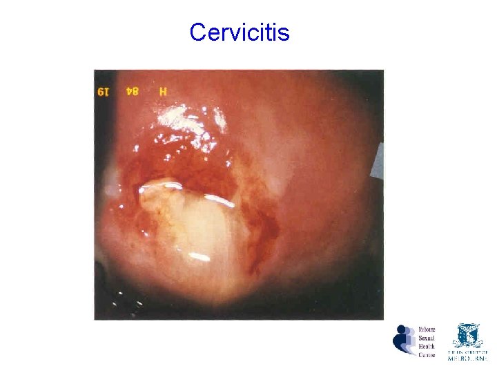 Cervicitis Cervicitis