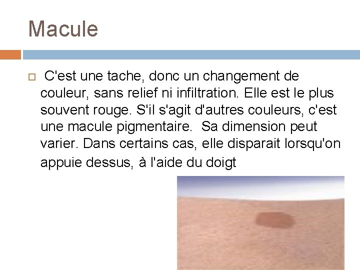 Macule C'est une tache, donc un changement de couleur, sans relief ni infiltration. Elle