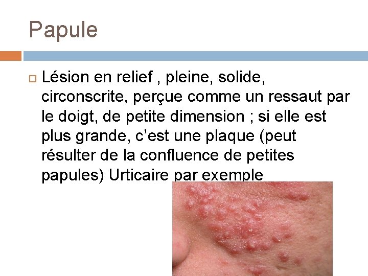 Papule Lésion en relief , pleine, solide, circonscrite, perçue comme un ressaut par le