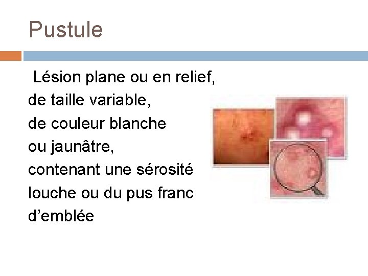 Pustule Lésion plane ou en relief, de taille variable, de couleur blanche ou jaunâtre,