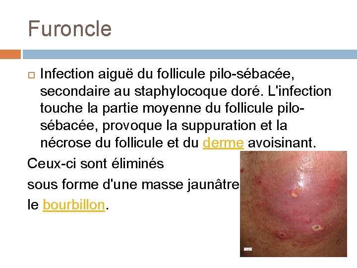 Furoncle Infection aiguë du follicule pilo-sébacée, secondaire au staphylocoque doré. L'infection touche la partie