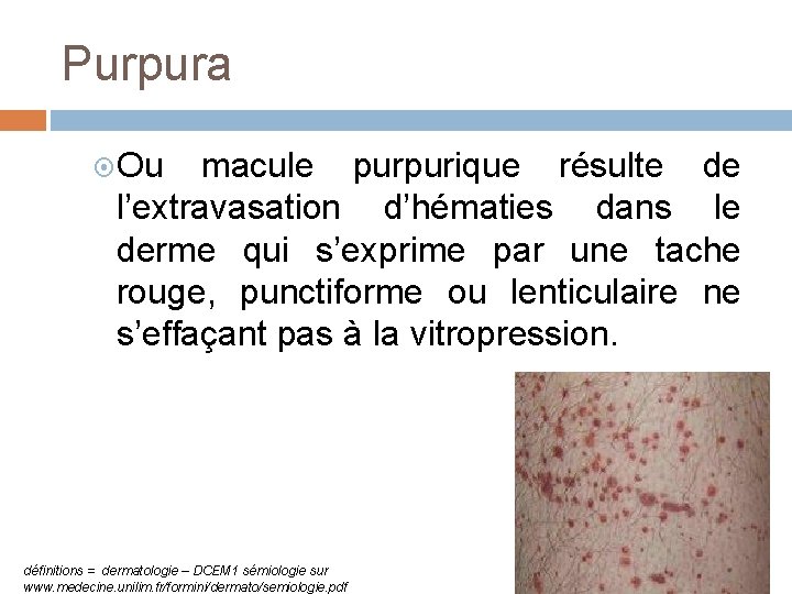 Purpura Ou macule purpurique résulte de l’extravasation d’hématies dans le derme qui s’exprime par