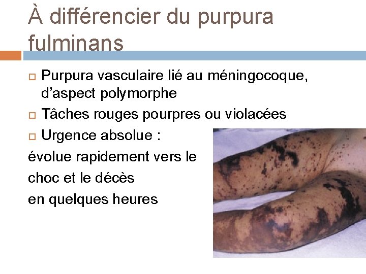 À différencier du purpura fulminans Purpura vasculaire lié au méningocoque, d’aspect polymorphe Tâches rouges