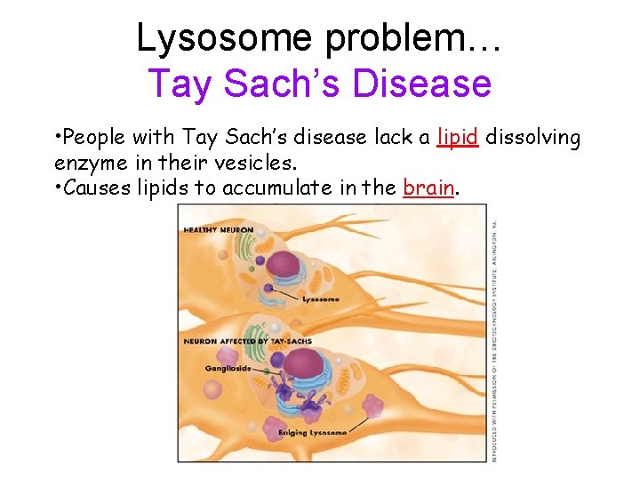 Lysosome problem… Tay Sach’s Disease • People with Tay Sach’s disease lack a lipid