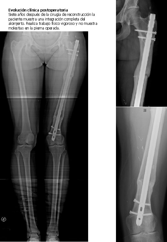 Evolución clínica postoperatoria Siete años después de la cirugía de reconstrucción la paciente muestra