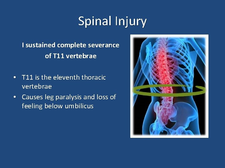 Spinal Injury I sustained complete severance of T 11 vertebrae • T 11 is
