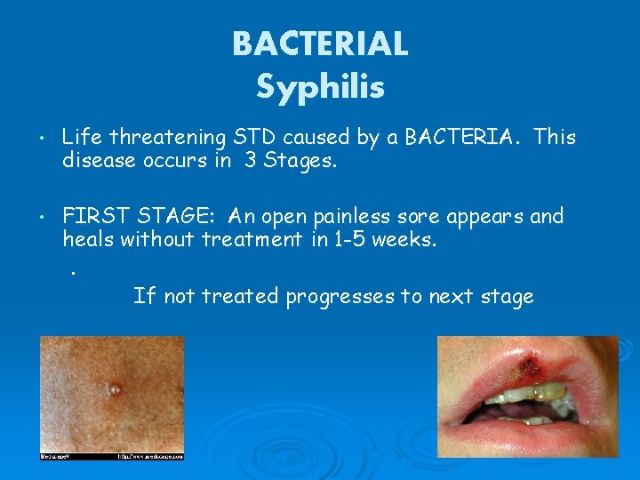 BACTERIAL Syphilis • Life threatening STD caused by a BACTERIA. This disease occurs in